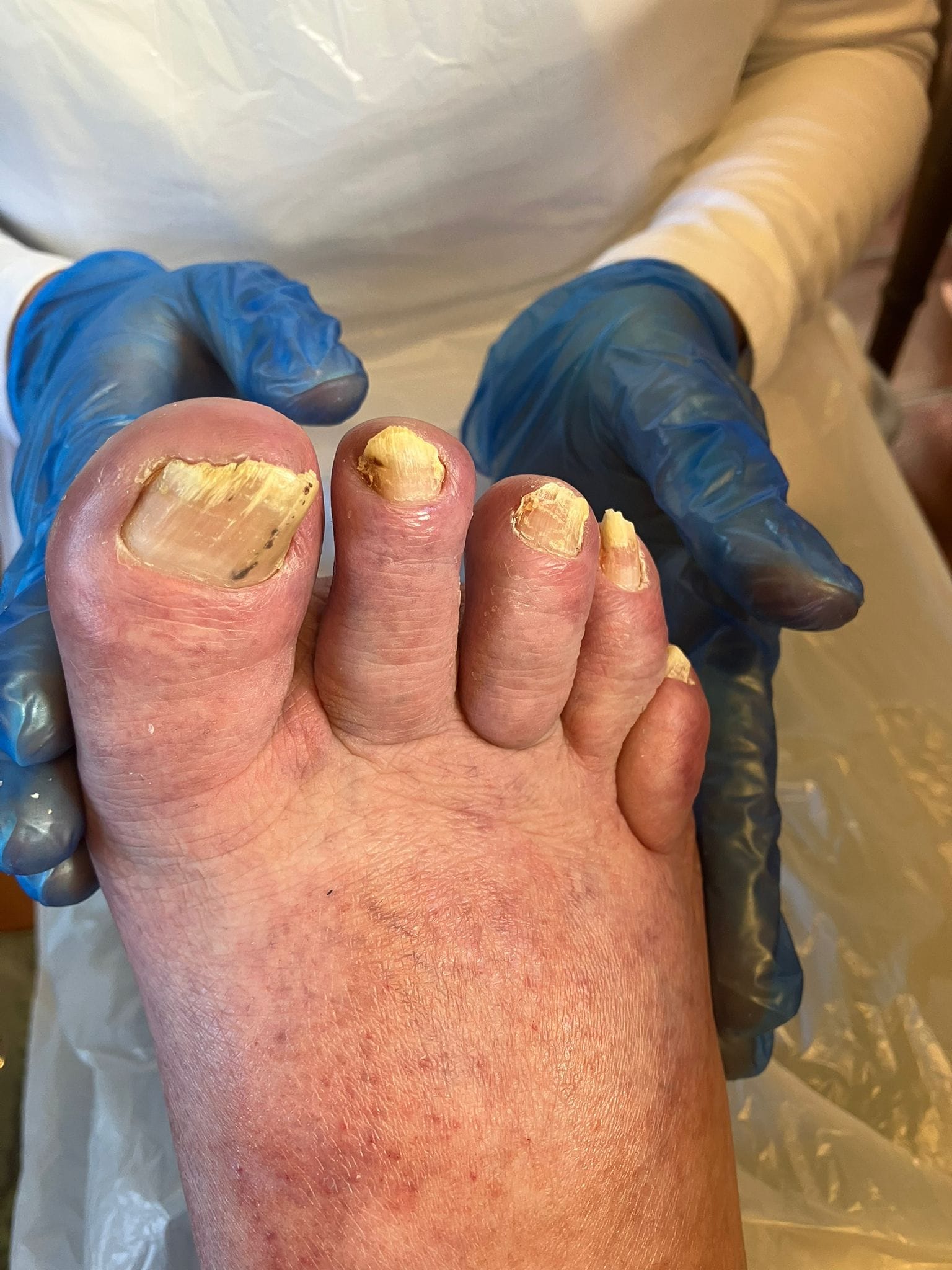 treatment of thickened nails